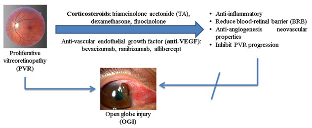 Intravitreal Administration of Corticosteroids and Anti-Vascular Endothelial Growth Factor (Anti-VEGF) Agents to Prevent Proliferative Vitreoretinopathy in Open Globe Injury: A Review 