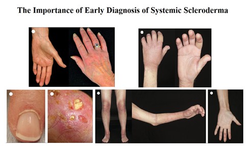 The Importance of Early Diagnosis of Systemic Scleroderma 