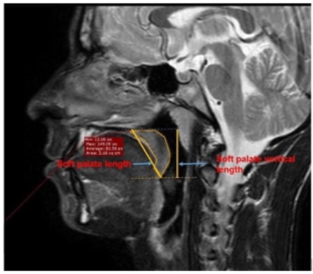 Morphological Analysis of Soft Palate Using MRI in Healthy Individual 