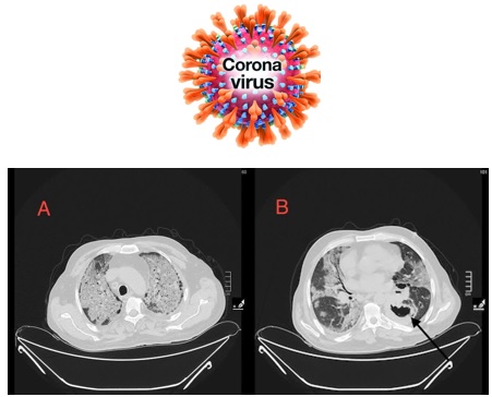 Mortality and Prevalence of COVID-19 in Variable Cancer Subtypes with Radiological Correlation at the King Hussein Cancer Center 
