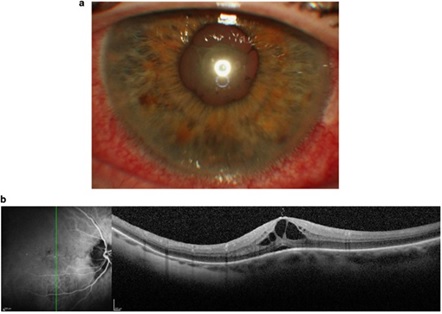 Comparison Between Intravitreous Fluocinolone Acetonide Implant, Ozurdex Implant, and Cyclosporine in Treatment of Noninfectious Uveitic Macular Edema 
