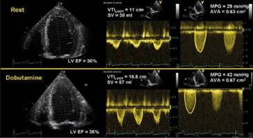 Echocardiographic Assessment of the Aortic Stenosis Valve Area: Parameters and Outcome 