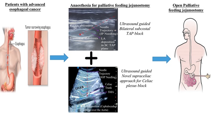 Efficacy of Ultrasound Guided Bilateral Subcostal Tap Block and Ultrasound Guided Celiac Plexus Block Using a Novel Supra Celiac Approach for Anaesthesia during Open Palliative Feeding Jejunostomy- A feasibility Study 